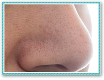 注意！間違った毛穴ケアで逆効果になっている。